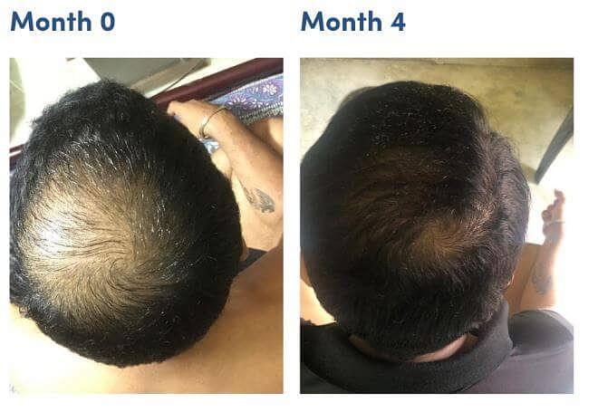 minoxidil pictures before and after man matters