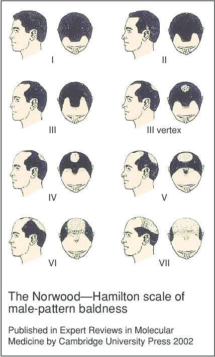 7 Stages of Male Pattern Baldness: Male Balding Patterns 101