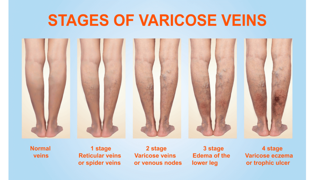 Stages of Varicose Veins