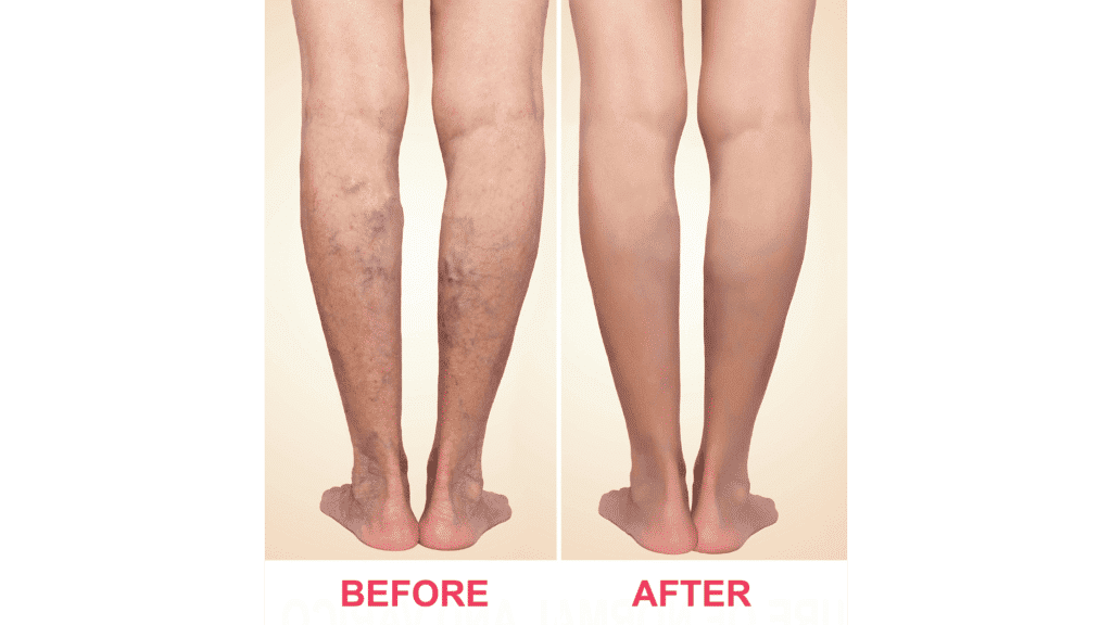 Ayurvedic Treatments For Varicose Veins