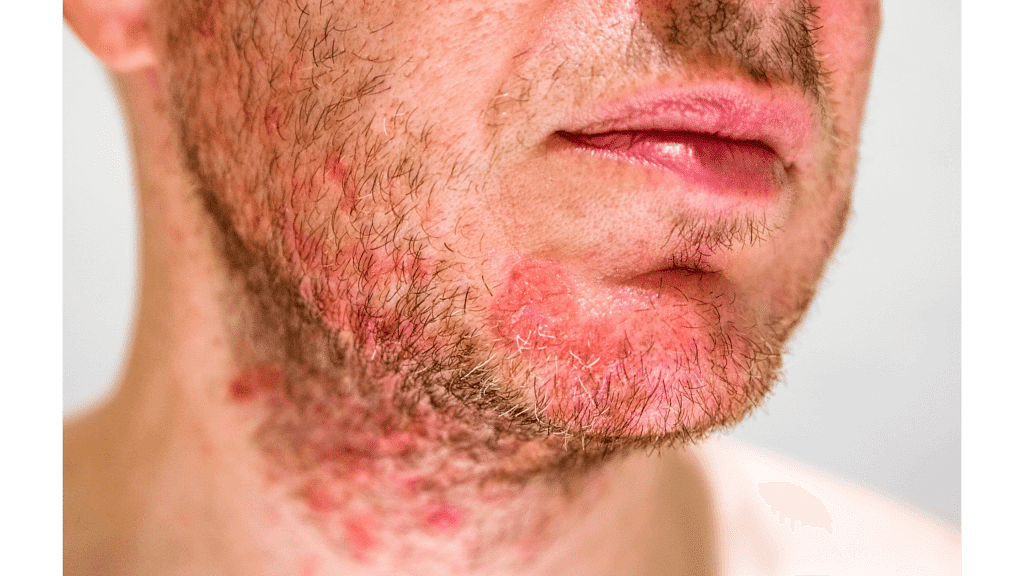 Symptoms of Seborrheic Dermatitis ​