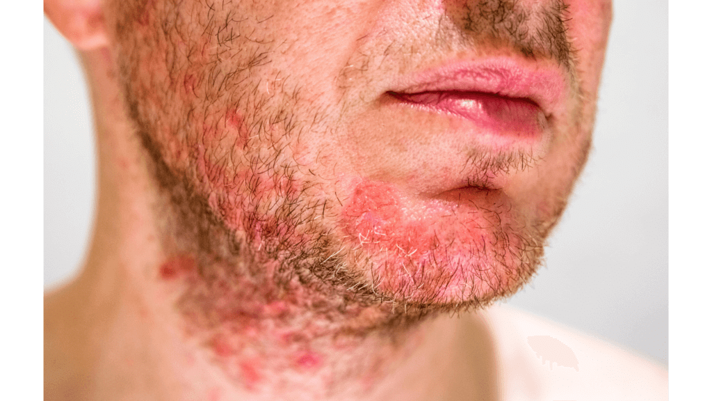 Symptoms of Seborrheic Dermatitis ​