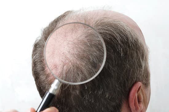 Consider hair transplants if you are balding