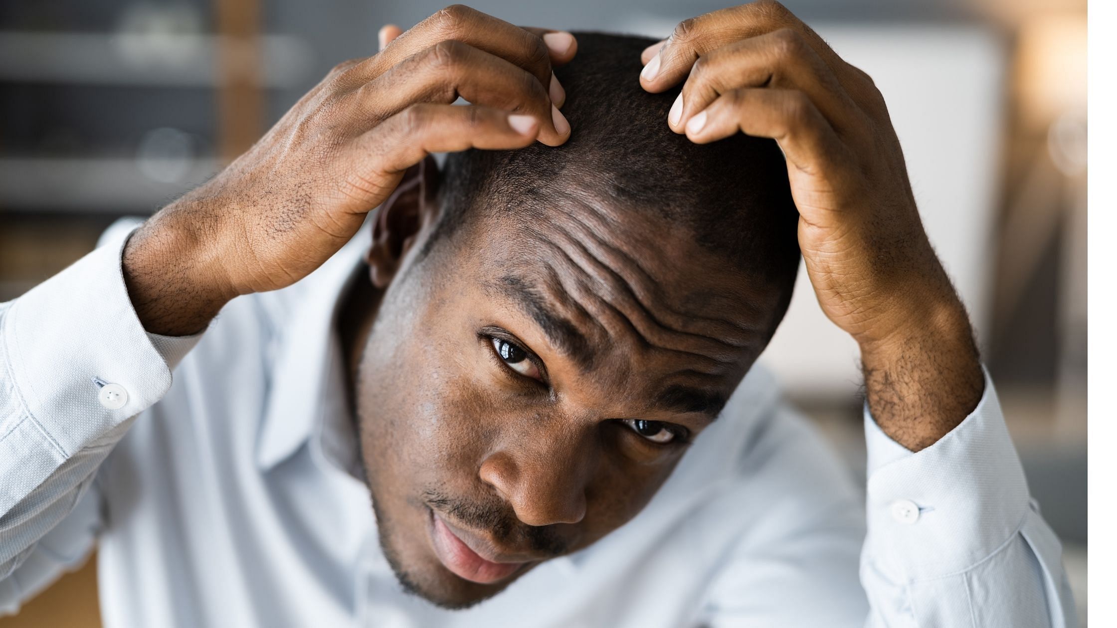 Dandruff  The Reason for Your Hair fall